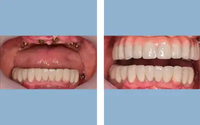 Before and After